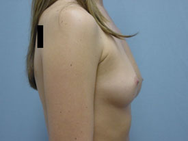 Breast Augmentation Saline