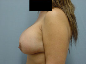 Breast Augmentation Saline