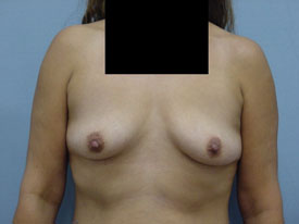 Breast Augmentation Saline
