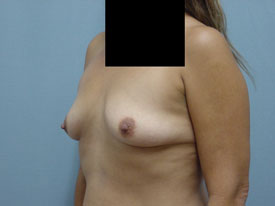 Breast Augmentation Saline