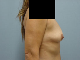Breast Augmentation Saline