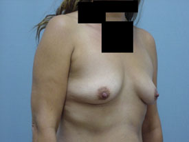 Breast Augmentation Saline