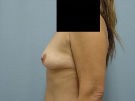 Breast Augmentation Saline