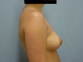 Breast Augmentation Saline