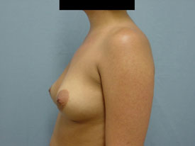 Breast Augmentation Saline