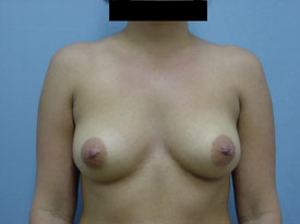 Breast Augmentation Saline