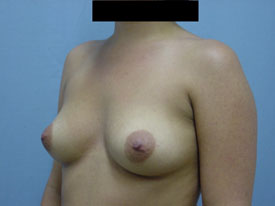 Breast Augmentation Saline