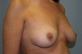 Breast Augmentation Gel