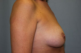 Breast Augmentation Gel