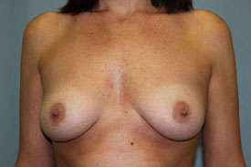 Breast Augmentation Gel