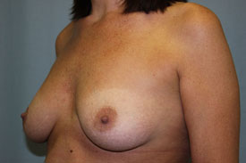 Breast Augmentation Gel