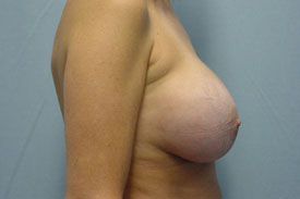 Breast Augmentation Gel