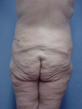Tummy Tuck-Panniculectomy