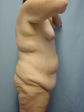 Tummy Tuck-Panniculectomy