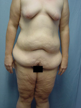 Tummy Tuck-Panniculectomy