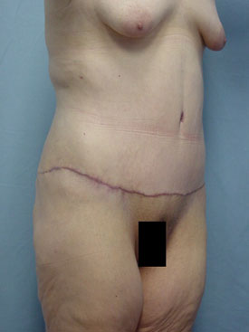 Tummy Tuck-Panniculectomy