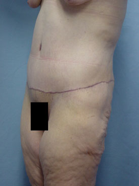 Tummy Tuck-Panniculectomy