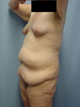Tummy Tuck-Panniculectomy