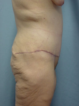 Tummy Tuck-Panniculectomy