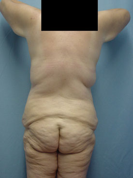 Tummy Tuck-Panniculectomy