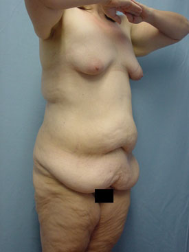 Tummy Tuck-Panniculectomy