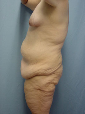 Tummy Tuck-Panniculectomy