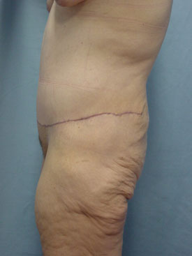 Tummy Tuck-Panniculectomy