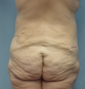 Body Lift