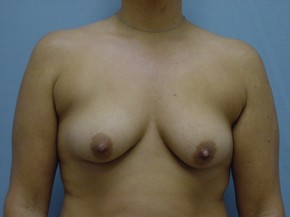 Asymmetry or Tuberous Breasts