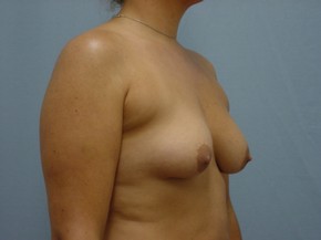 Asymmetry or Tuberous Breasts