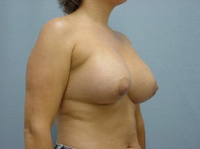Asymmetry or Tuberous Breasts