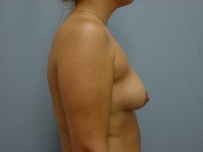 Asymmetry or Tuberous Breasts