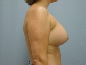 Asymmetry or Tuberous Breasts
