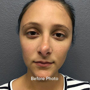 Rhinoplasty