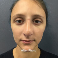 Rhinoplasty