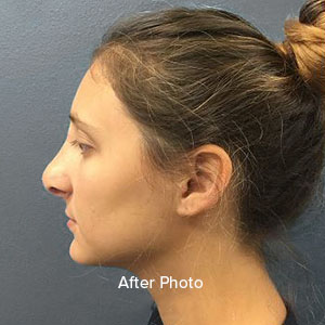 Rhinoplasty