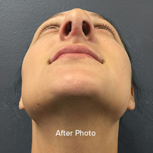 Rhinoplasty