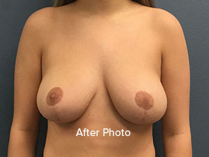 Breast Reduction