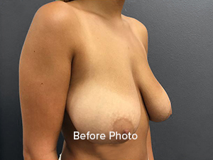 Breast Reduction