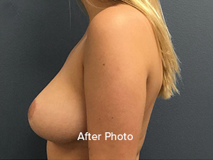 Breast Reduction