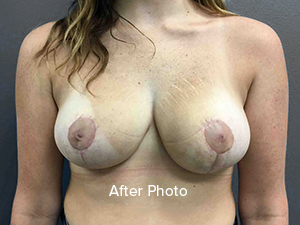 Breast Reduction