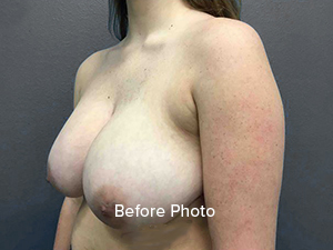 Breast Reduction