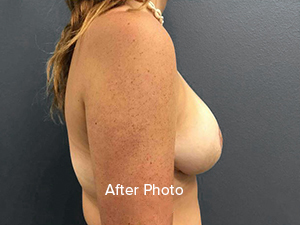 Breast Reduction