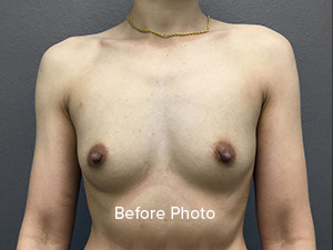 Breast Augmentation