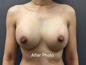 Breast Augmentation