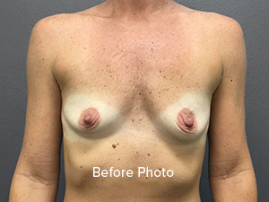 Breast Augmentation