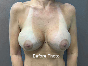 Breast Augmentation