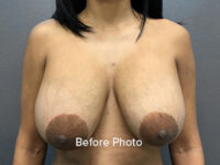 Breast Reduction