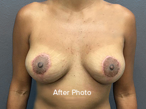 Breast Reduction