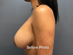 Breast Reduction